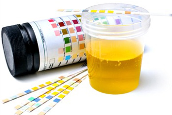 urine analysis